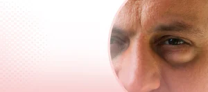 Eye Bags A Common Concern Among Many