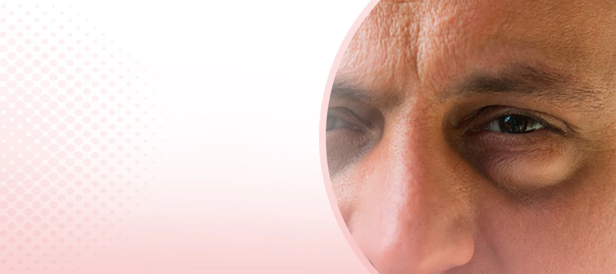 Eye Bags A Common Concern Among Many