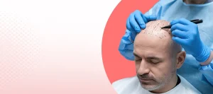 Hair transplant