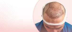How to care for your hair after a transplant