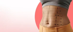 Is Liposuction Surgery Safe Recovery and Results