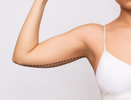 Brachioplasty arm fat removal