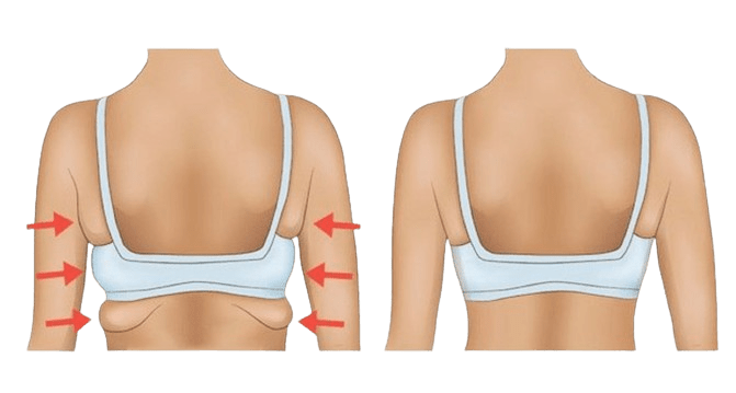 Back Fat / Bra Roll Reduction