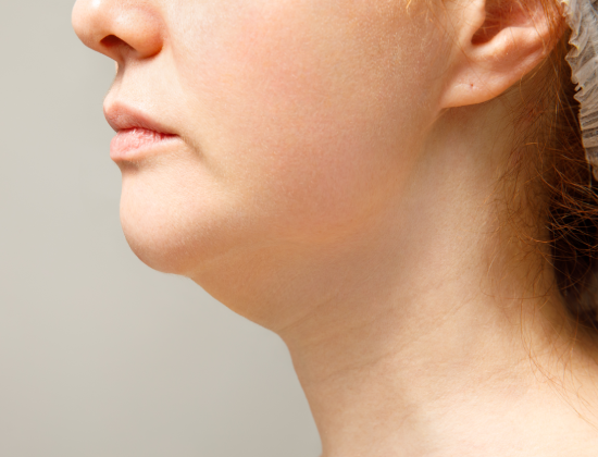Double Chin Reduction