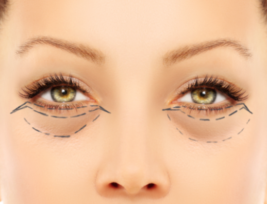 Blepharoplasty Eye Bag Treatment