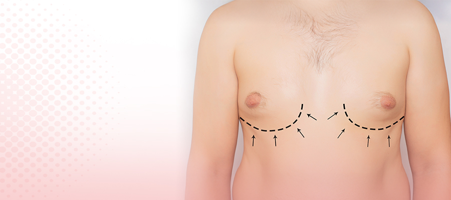 Gynecomastia Surgery
