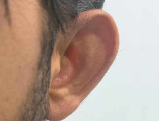 Otoplasty Ear Pinning Surgery