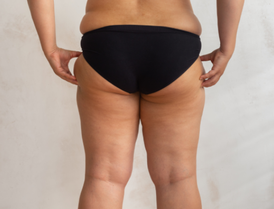 Outer thigh liposuction surgery